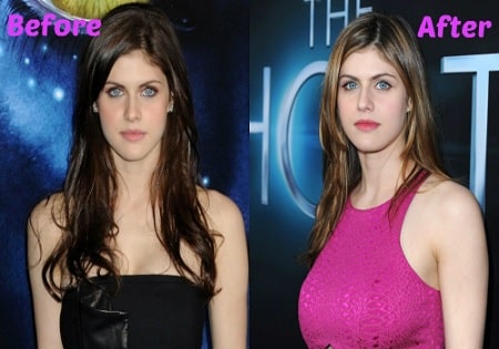 A picture of Alexandra Daddario before and after the breast implants.